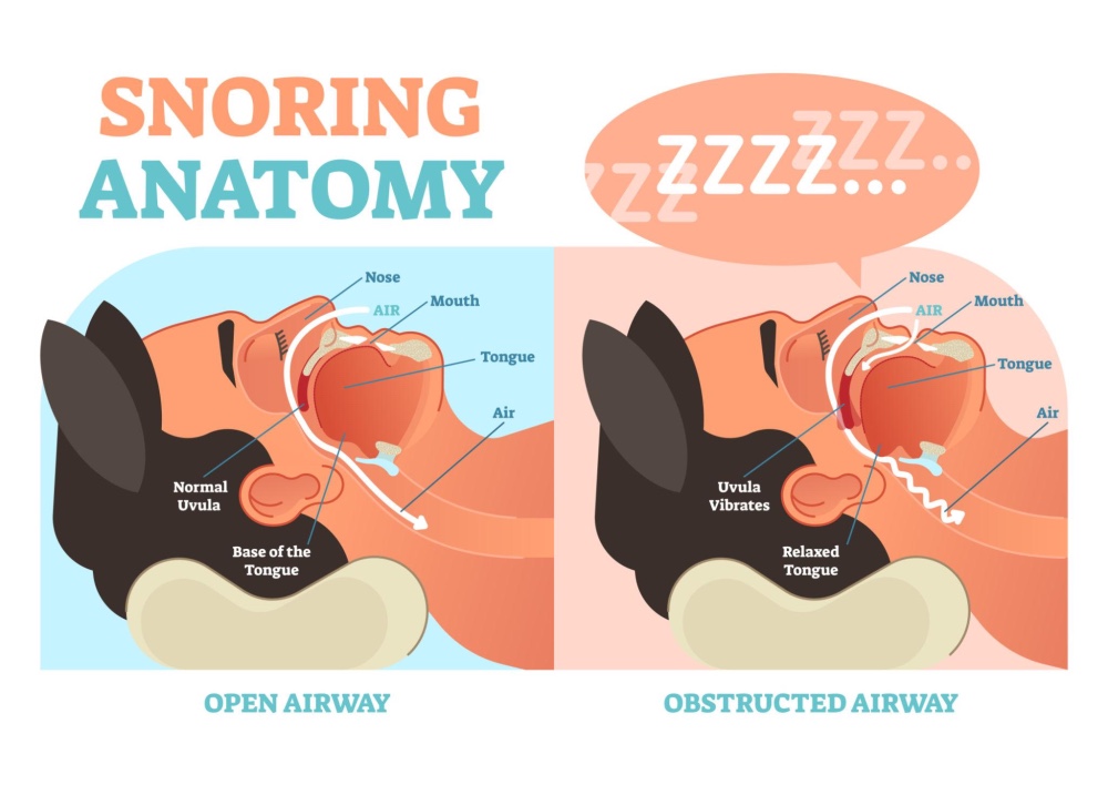“Diagram showing how airway narrowing during sleep causes snoring, with soft palate vibration and mouth breathing.”